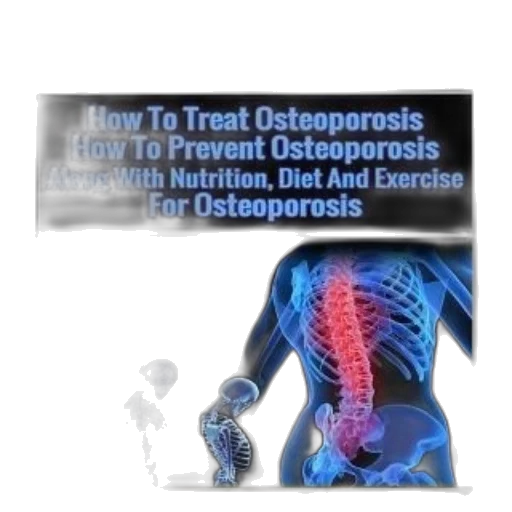 osteoporosis, how, treat, prevent, nutrition, diet, exercise, ace transparent PNG cut-out