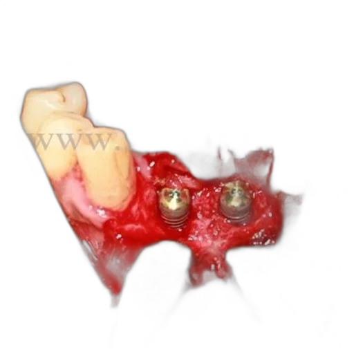 jewelry, crown, food, weapon, 3d render, dental, implant, surgery transparent PNG cut-out