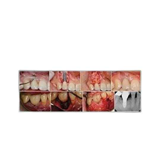crown, cover, dental, implant, complications, etiology, prevention, treatment transparent PNG cut-out