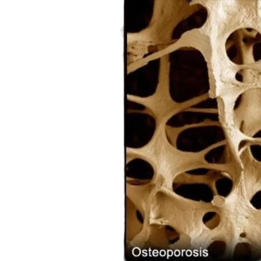 comparison, bone, density, healthy, left, dense, structure, osteoporotic transparent PNG cut-out